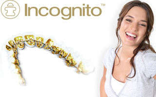 Эффективность и незаметность брекетов Incognito